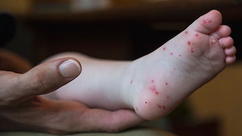 Alerta por virus mano, pie y boca en Perú: Signos de alerta y cómo se contagia