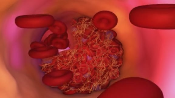 La evidencia sugiere que el miedo a efectos secundarios llevó a que muchos pacientes abandonaran un tratamiento que salva vidas (Pexel)