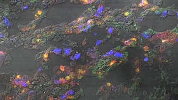 Microscopía confocal de un tumor de mama que muestra el reclutamiento de células mononucleares, glóbulos blancos que forman parte del sistema inmunitario
