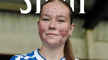 La futbolista Skye Stout sufre