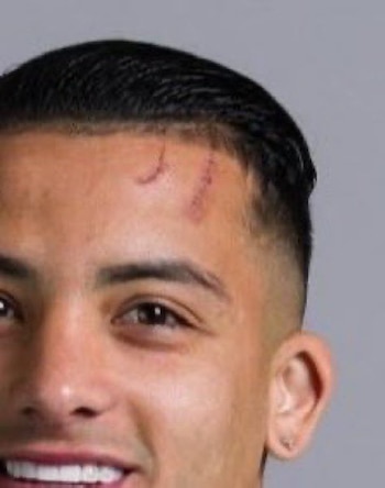 Cicatriz de Kevin Castaño tras