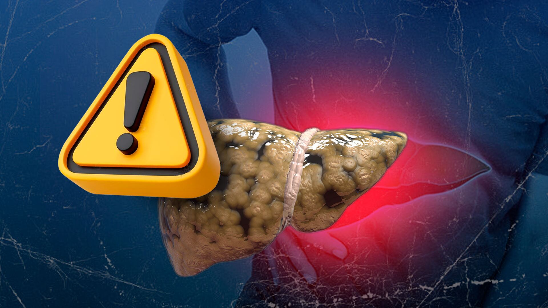 En sus etapas más avanzadas el hígado graso suele dar dolorosos síntomas. (Foto: Infobae México/ Jesús Aviles)