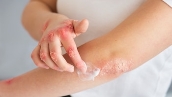 Un fármaco contra la leucemia podría aliviar la psoriasis