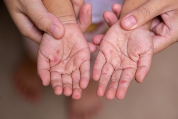 Autoridades sanitarias mantienen vigilancia epidemiológica por nuevos casos sospechosos. (FOTO: New Mexico University)