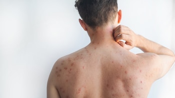 Sarampión en Perú: por qué la vacunación es clave para evitar casos graves y muertes