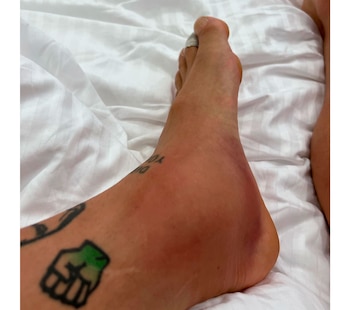 La impactante foto del tobillo