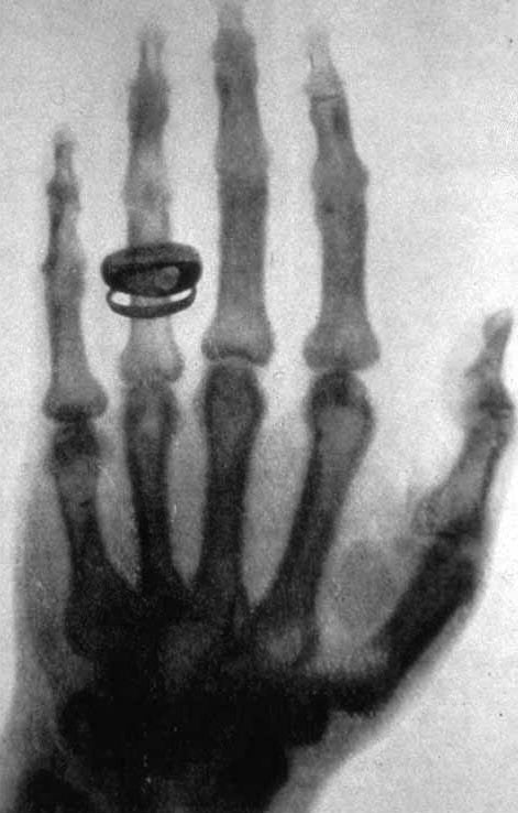 La primera radiografía de la historia (Wikimedia Commons)