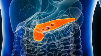 Se trata de una triple