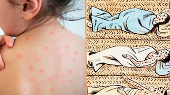 El sarampión regresa: Después de