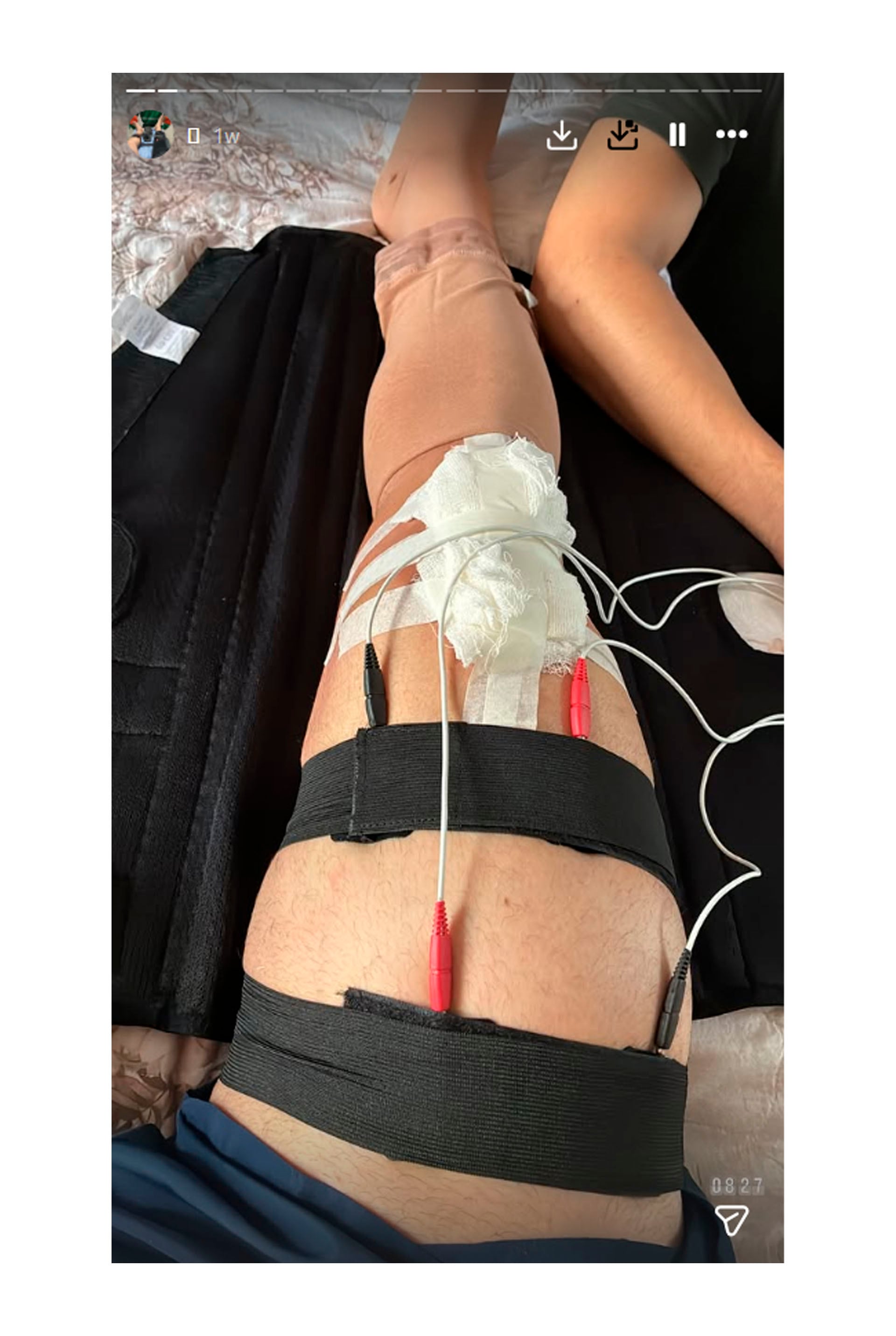 Recibió tratamiento de rehabilitación con vendajes y electrodos conectados a la pierna (@ranierilf)