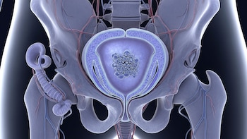 Un nuevo método de detección de cáncer de próstata reduce el número de biopsias innecesarias