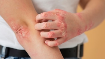 9 factores que pueden desencadenar la urticaria crónica y cómo aliviar sus síntomas, según expertos