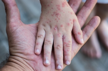 Las autoridades sanitarias advirtieron que un solo caso de sarampión puede mantener la circulación del virus y que la falta de vacunación completa eleva el riesgo de contagio.