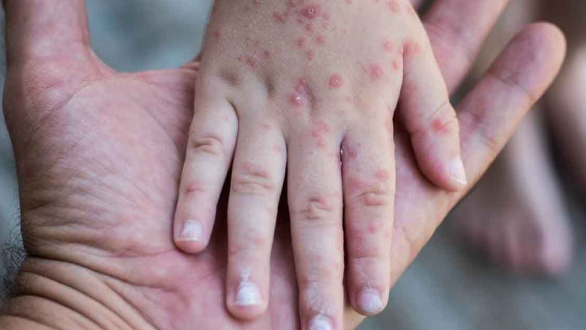 15 de los 17 casos confirmados en 2026 se registraron en esta región, especialmente en Juliaca y Putina Punco.