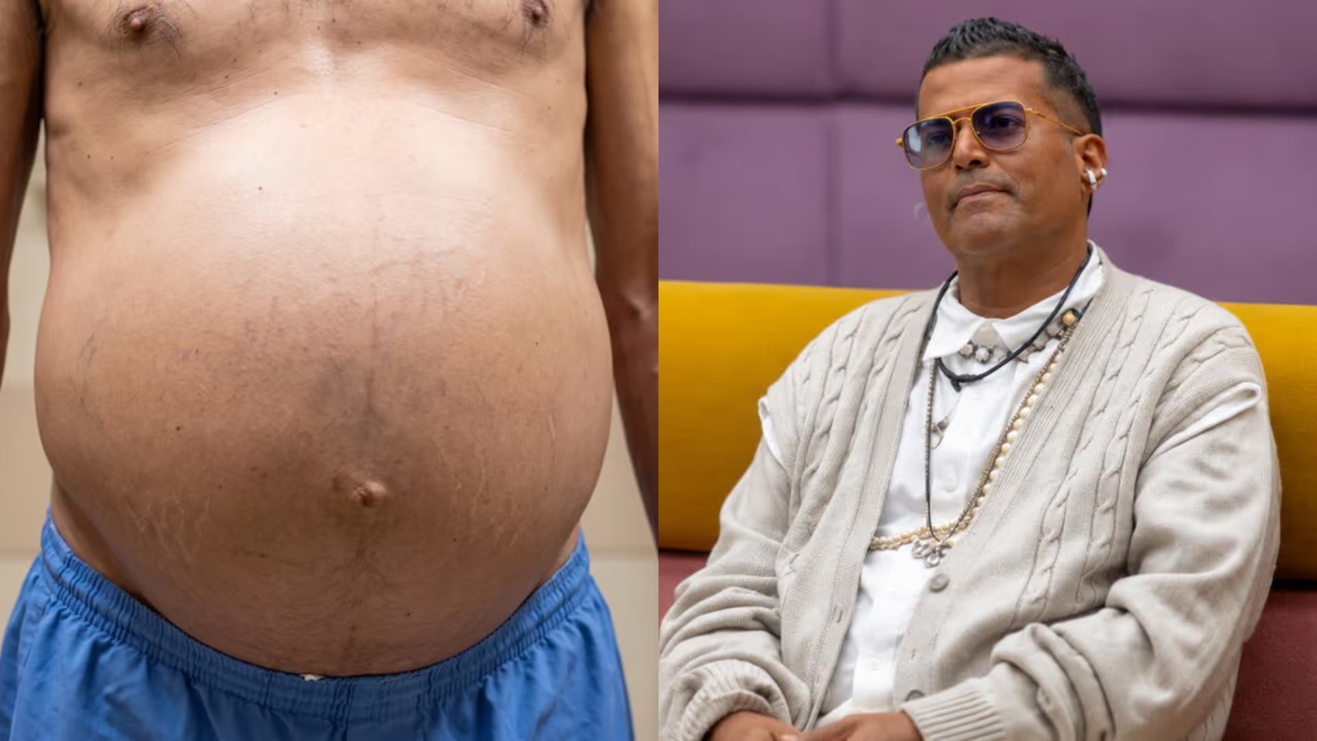 Ojos amarillos y abdomen inflamado: Detecta las 4 etapas del hígado graso antes de que sea irreversible
(RS)