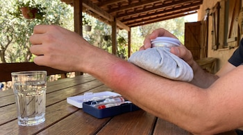 Un hombre aplica una compresa de hielo en su antebrazo que presenta enrojecimiento. Sobre una mesa de madera hay un vaso con agua y un kit de primeros auxilios abierto.
