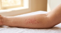 ¿Qué es la alergia al sol? Síntomas, causas y tratamiento