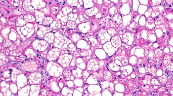 Muestra microscópica teñida de rosa y morado que contiene numerosas cavidades circulares blancas y núcleos celulares.
