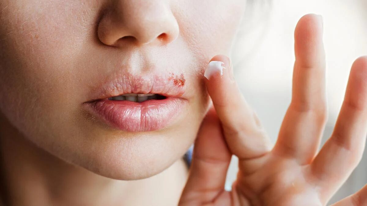 El cuidado de la piel de los labios es clave, ya que quemaduras solares, acné severo o lesiones pueden facilitar la aparición de herpes labial (foto: MayoClinic)