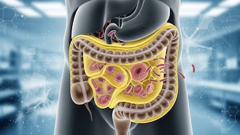 La grasa cerca del colon
