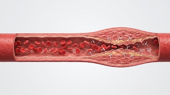 Corte longitudinal de una arteria con glóbulos rojos en su interior, una pared vascular engrosada y moléculas flotantes.