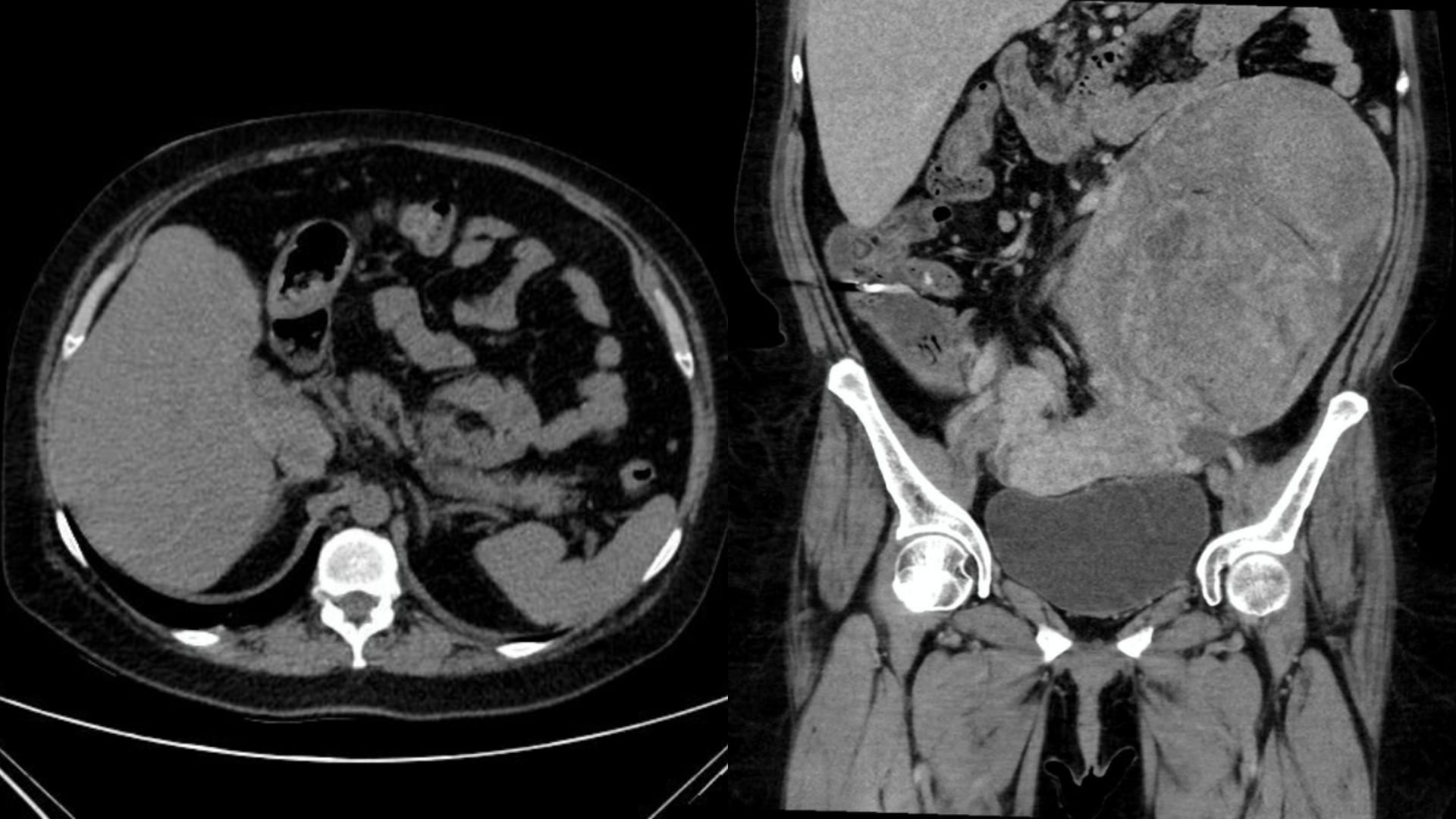 Exitosa cirugía en Iquitos: extraen tumor del tamaño de una sandía adherido a varios órganos. (Foto composición: Infobae Perú/Agencia Andina)