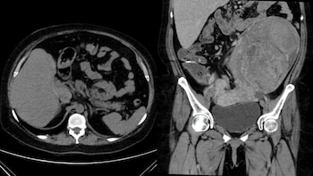 Exitosa cirugía en Iquitos: extraen tumor del tamaño de una sandía adherido a varios órganos. (Foto composición: Infobae Perú/Agencia Andina)