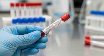 Mano enguantada sosteniendo un tubo de ensayo rojo con etiqueta "Hepatitis A Positive", que contiene sangre, y más tubos de ensayo borrosos al fondo.