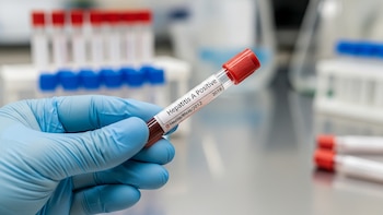 Crece la hepatitis A en Argentina: el 75% de casos corresponde a adultos jóvenes