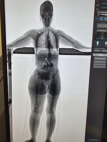 Pantalla con una radiografía de cuerpo entero que presenta una figura humana de pie con objetos densos en la zona abdominal y pélvica
