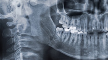 Radiografía dental panorámica de la mandíbula, los dientes con obturaciones y restauraciones, parte del cráneo y columna cervical.