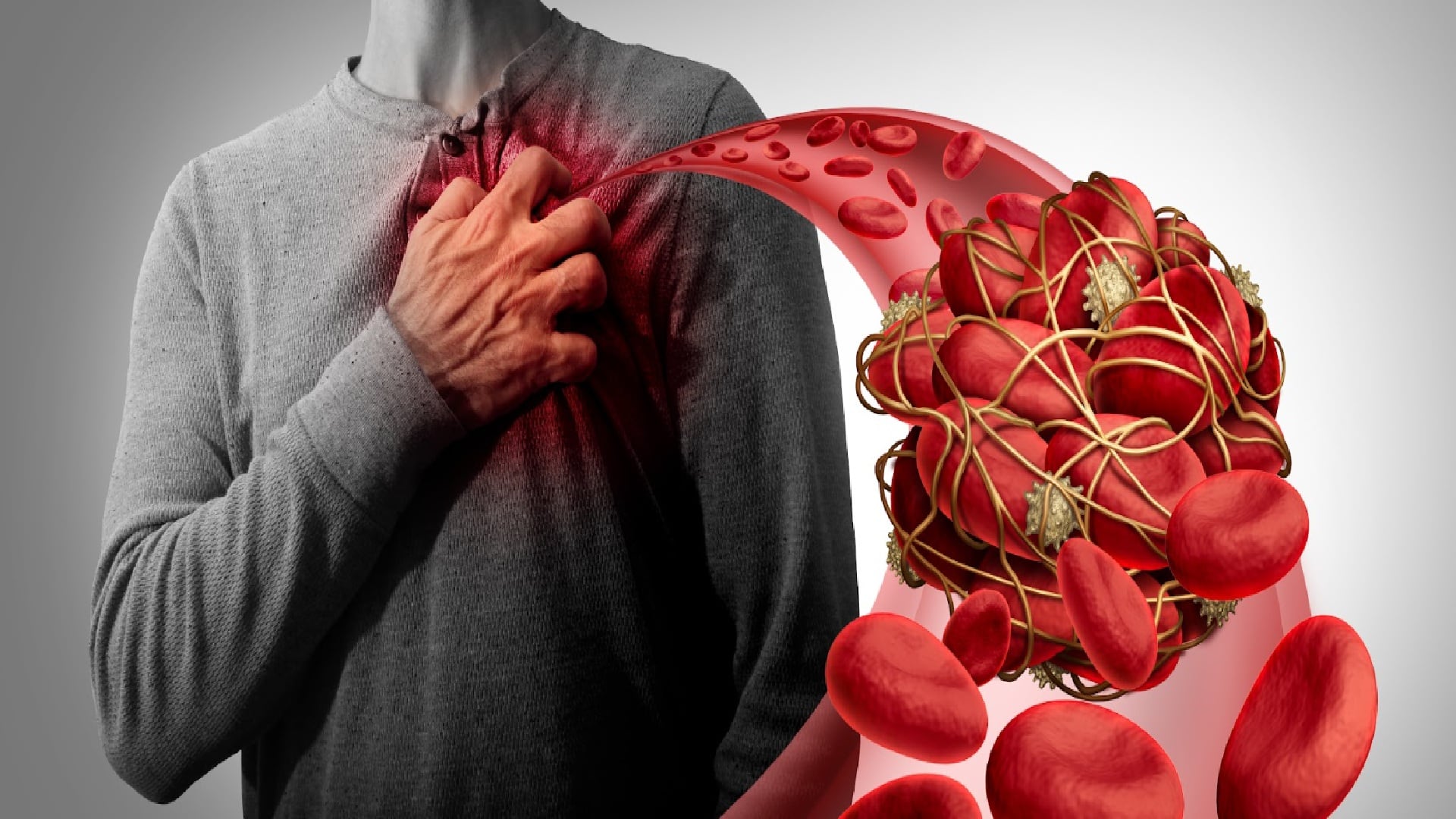 Trombosis infarto al miocardio (especial)