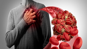 Trombosis infarto al miocardio