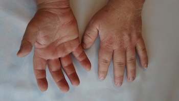 Qué es la acromegalia, la