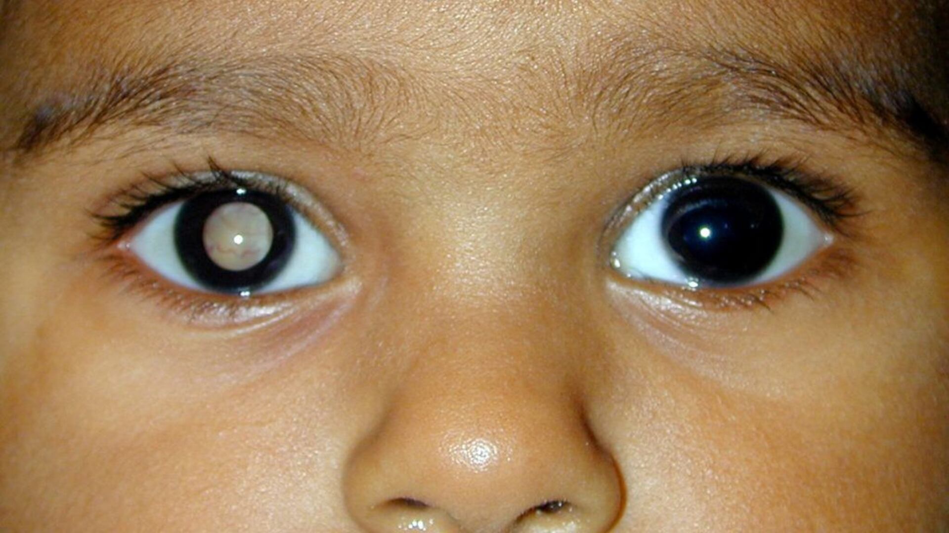 Retinoblastoma, cáncer ocular, niños - Perú - 11 de febrero (APEC Blog)