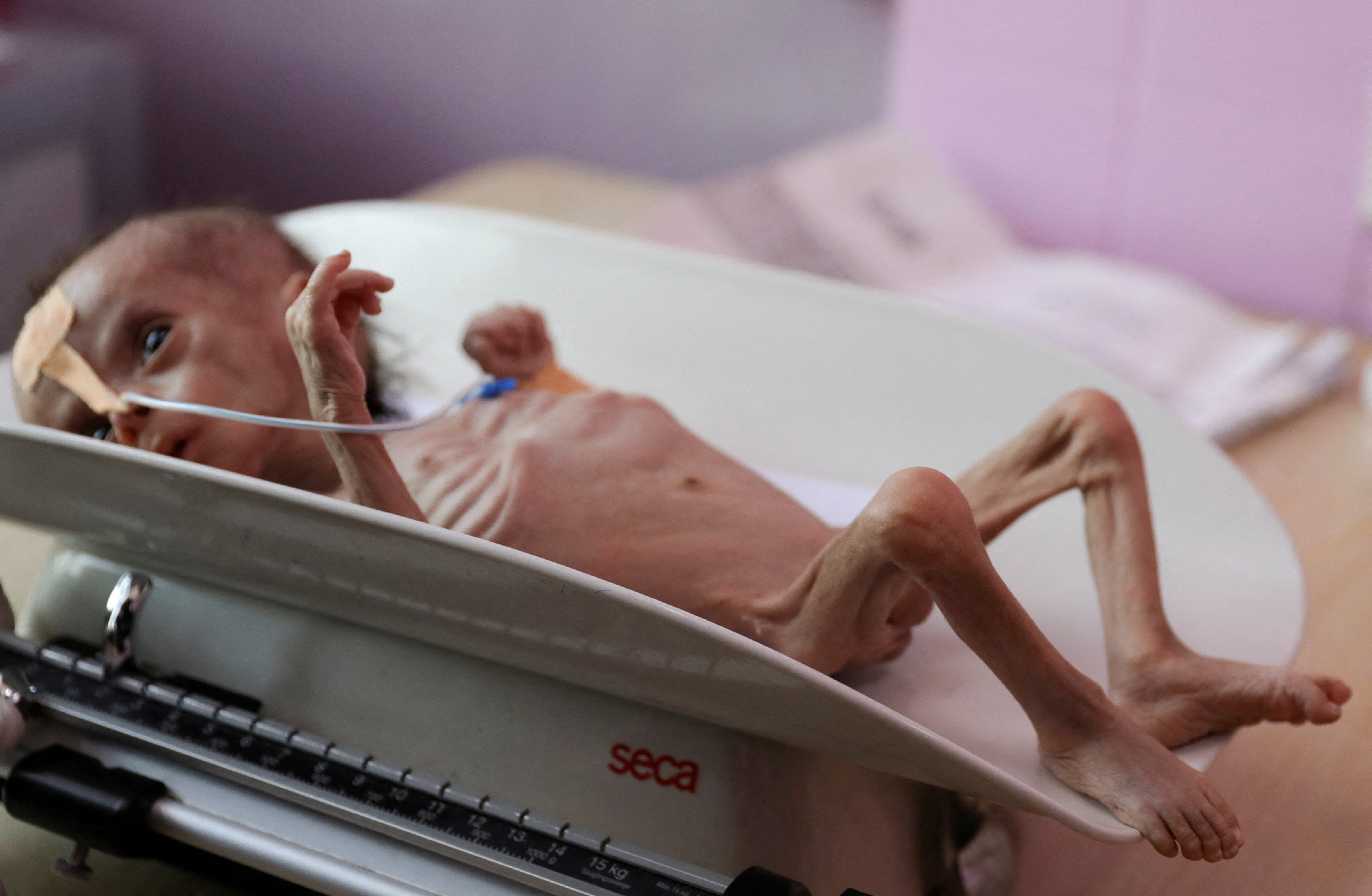 Un niño de seis meses, Wisam al-Salafi, yace en una balanza en un centro de tratamiento de desnutrición en Saná, Yemen, el 26 de agosto de 2024. El conflicto yemení ha durado más de una década y ha causado un colapso humanitario en el país. (Foto: REUTERS / Khaled Abdullah / Archivo)