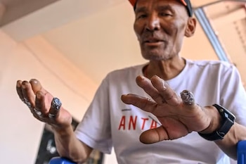 Un hombre con gorra y camiseta blanca levanta sus manos. Varios dedos tienen las puntas oscuras. Un reloj negro se ve en la muñeca derecha