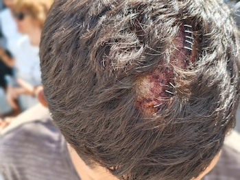 Un migrante en Ceuta muestra sus heridas, agredido por militares españoles, según Amnistía Internacional. (EFE/AI)
