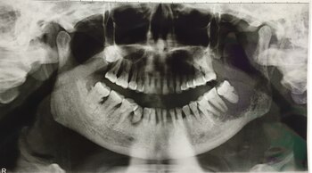 Cáncer oral en una película