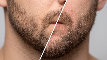 Mitad izquierda de barba masculina con piel limpia y vello húmedo. Mitad derecha de la misma barba con caspa blanca y piel enrojecida.