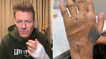 Imagem compartilhada: à esquerda, homem com pulseira na mão esquerda; À direita, close de uma mão com pontos escuros e tatuagens.