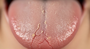 La sequedad y las grietas