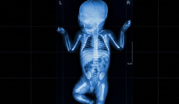 Radiografía de cuerpo completo de un infante mostrando su esqueleto con claridad y algunos órganos internos en tonos azules sobre fondo negro