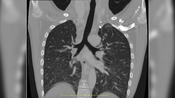 Corte coronal de una tomografía de tórax que incluye los pulmones, la tráquea, las vías respiratorias y la estructura ósea