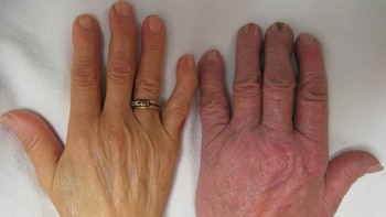 La anemia se puede convertir