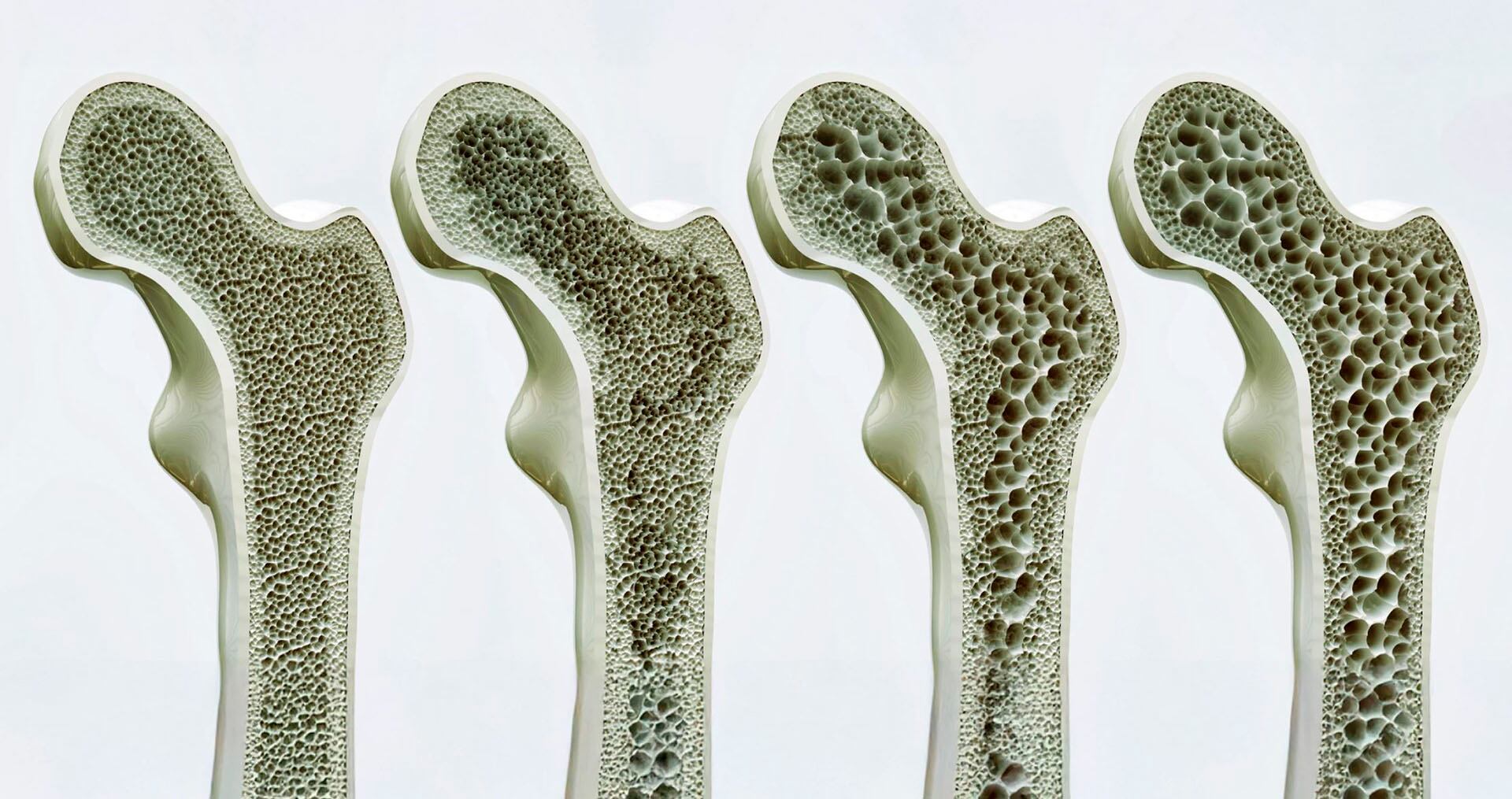 El riesgo de fracturas también aumenta con la edad, el sexo, la raza y los antecedentes familiares (Imagen Ilustrativa Infobae)