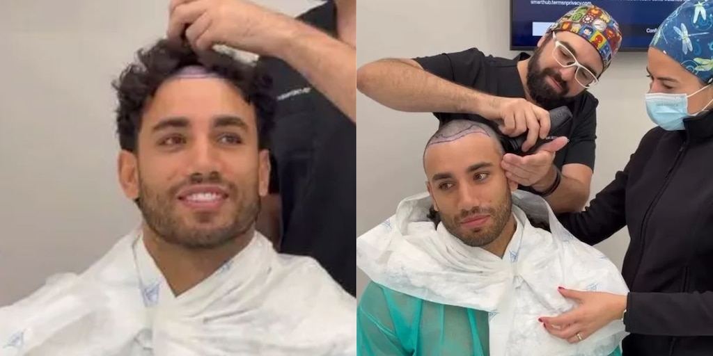 Said Palao sorprende al mostrar su cabeza rapada tras someterse a un trasplante capilar en España: “Esto recién empieza” - Infobae