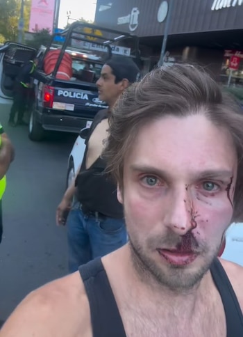 Joan Kuri sufrió lesiones en los ojos tras ser víctima de una agresión vial en el Periférico del Estado de México (IG)