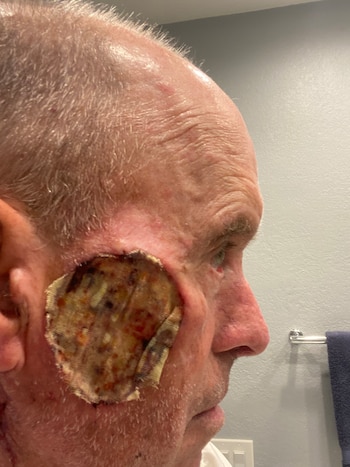 En 2023, los médicos extirparon una gran sección de la mejilla de Orwig tras diagnosticarle un melanoma en estadio 3. (Cortesía de Mark Orwig)