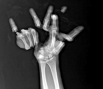 El uso inadecuado de pirotecnia